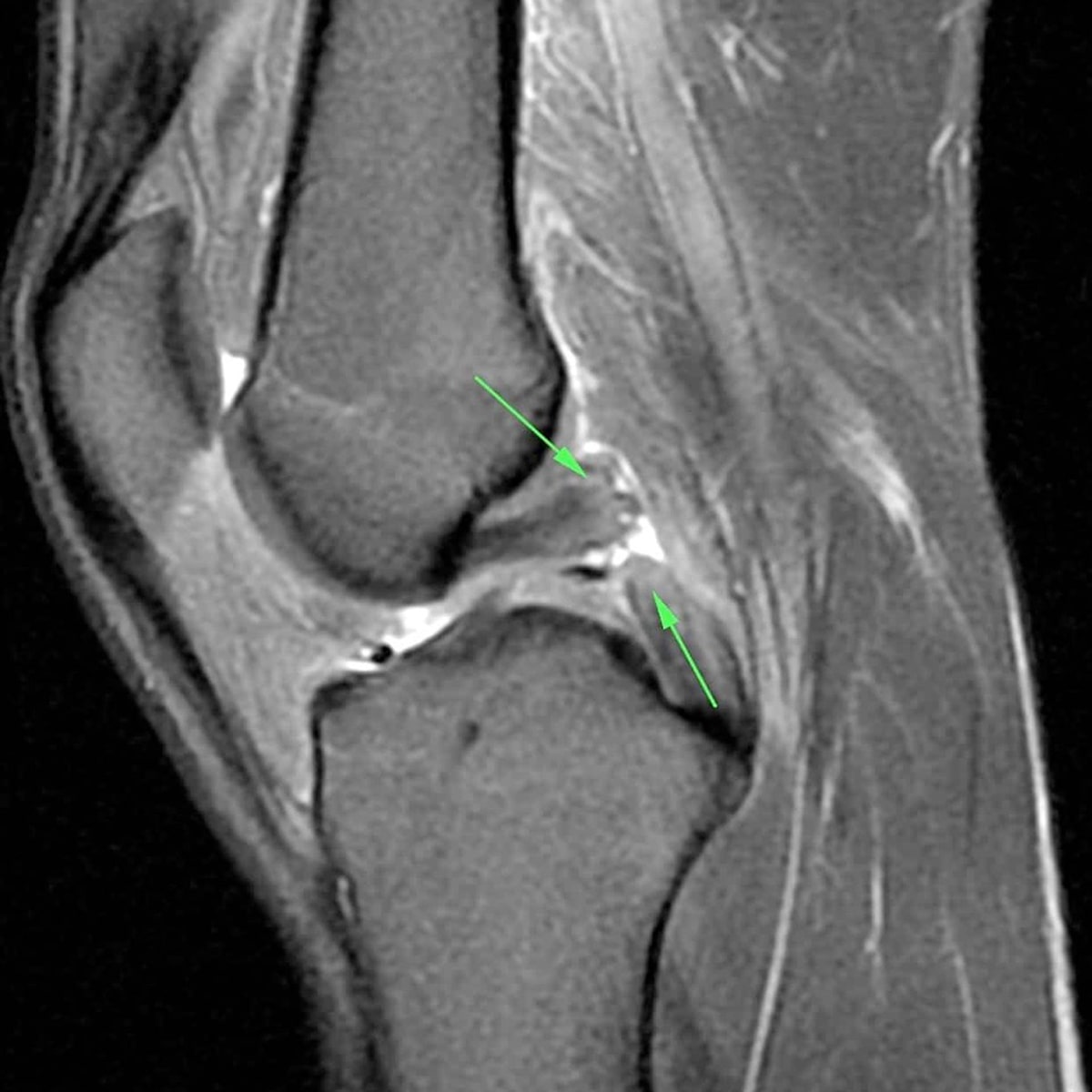 Ein MRT-Scan eines Knies vom Ortho Health Institut in München zeigt eine sagittale Ansicht mit grünen Pfeilen, die auf einen möglichen Riss oder eine Anomalie im Gelenk hinweisen, was wahrscheinlich auf ein Problem mit dem Meniskus oder anderen inneren Strukturen hinweist. Das Bild ist in Graustufen.