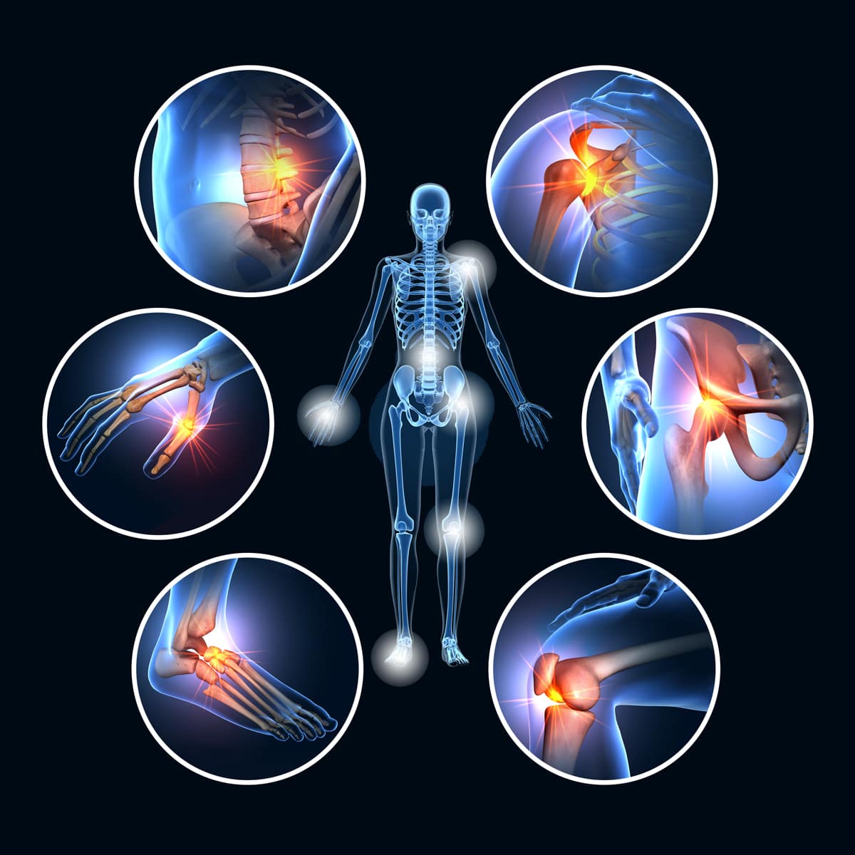 © Ortho Health Institut in München Eine digitale Illustration eines menschlichen Skeletts ist von sechs kreisförmigen Einschüben umgeben, die Nahaufnahmen von Schmerzpunkten in Rücken, Hüfte, Schulter, Knie, Knöchel und Handgelenk zeigen. Jeder Bereich ist rot und gelb hervorgehoben, um Entzündungen oder Verletzungen anzuzeigen. Dieses Werk wurde vom Ortho Health Institut in München erstellt.