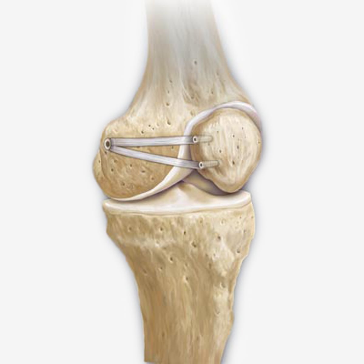 © Ortho Health Institut in München Eine detaillierte Darstellung der Anatomie des Kniegelenks, die sich auf die Platzierung von Nahtankern um die Kniescheibe konzentriert. Das Bild, das vom Ortho Health Institut in München bereitgestellt wurde, hebt die Knochenstruktur und das Bindegewebe hervor, die bei chirurgischen Reparaturverfahren beteiligt sind.