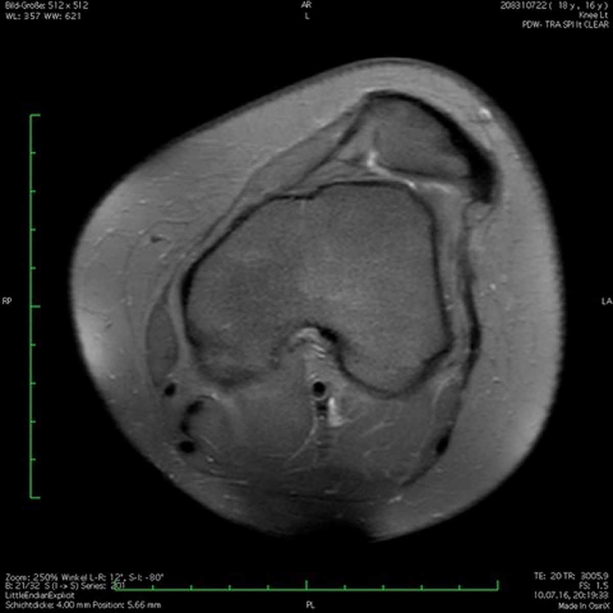 Ein Graustufen-MRT-Bild zeigt einen Querschnitt eines menschlichen Kniegelenks. Der detaillierte Scan, der am Ortho Health Institut in München durchgeführt wurde, zeigt verschiedene anatomische Strukturen, darunter Knochen, Knorpel und Weichteile. An den Rändern des Bildes sind Überwachungsinstrumente und Messungen sichtbar.