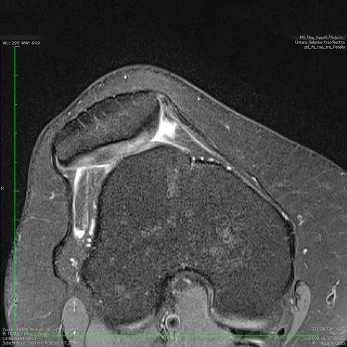Ein MRT-Bild des Ortho Health Instituts in München zeigt eine Querschnittsansicht eines Kniegelenks mit detaillierten Knochen, Knorpeln und umgebendem Weichgewebe. Das Graustufenbild zeigt verschiedene Schattierungen, die unterschiedliche Gewebedichten anzeigen, wobei grüne Messlinien und numerische Indikatoren den Scan umranden.